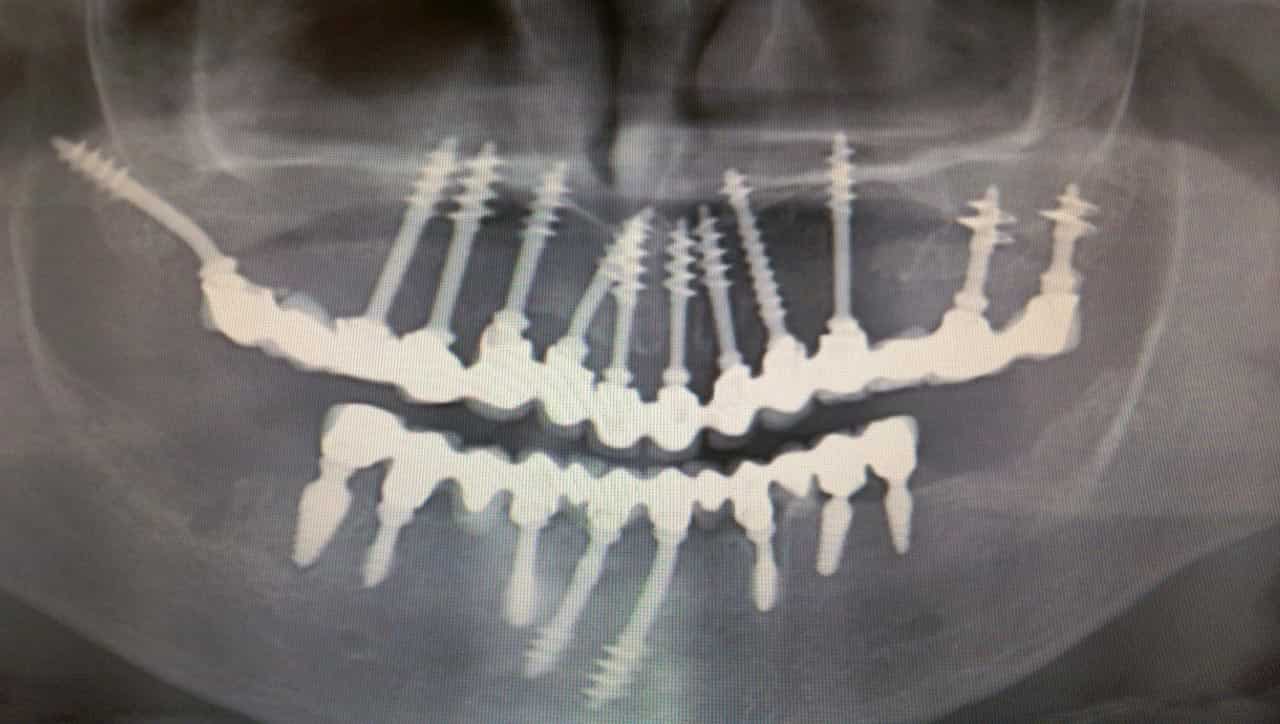 fog implantátum Budapesten