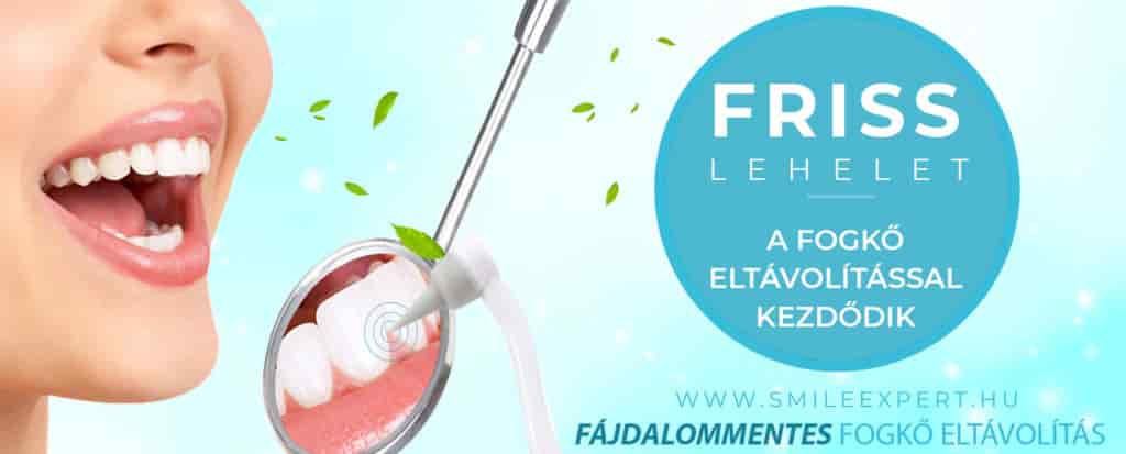 fogkő eltávolítás Budapest