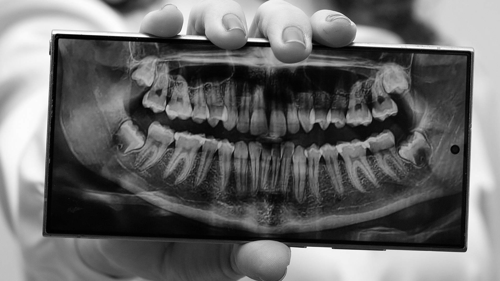 Szakszerű foggyökér eltávolítás a MyDent fogorvos Budapestnél